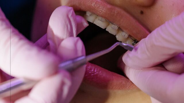 Can an Orthodontist Refuse to Remove Braces?