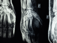 6 Types Of Injuries That Happen In Car Crashes