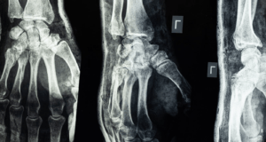 6 Types Of Injuries That Happen In Car Crashes