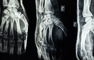 6 Types Of Injuries That Happen In Car Crashes