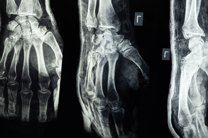 6 Types Of Injuries That Happen In Car Crashes