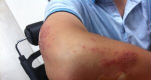 How To Settle Disputes With Your Boss After An Accident?