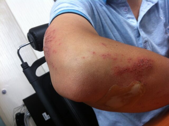 injury-g82f364082_1280